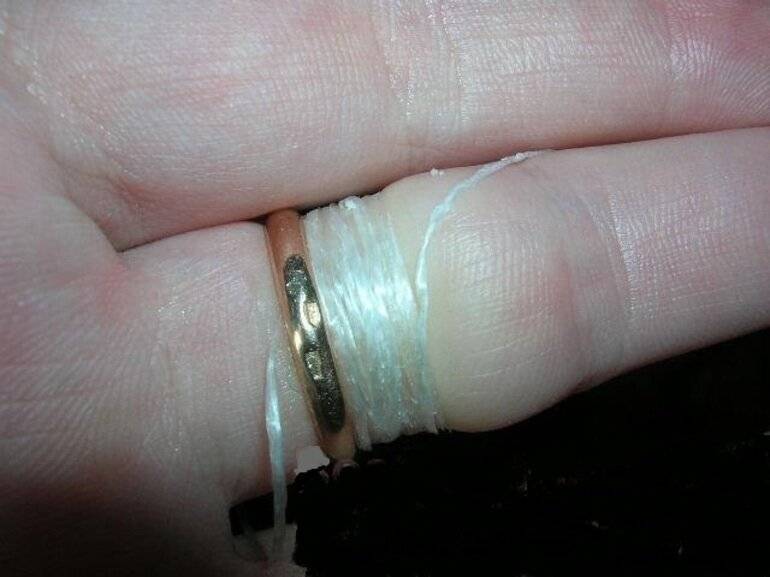 Как снять кольцо с опухшего пальца видео. Обручальное кольцо вросло в палец. Как снять кольцо с опухшего пальца.